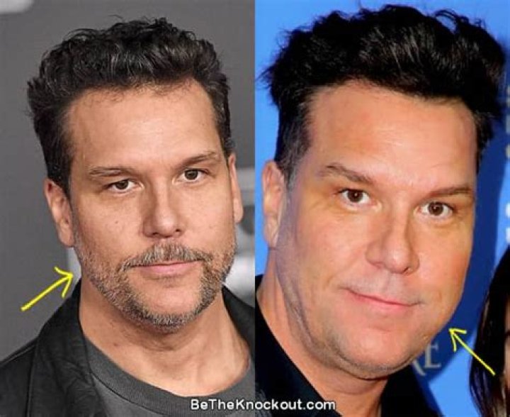 Dane Cook Facelift Botox And Lip Filler Before And After Plastic Surgery Photos