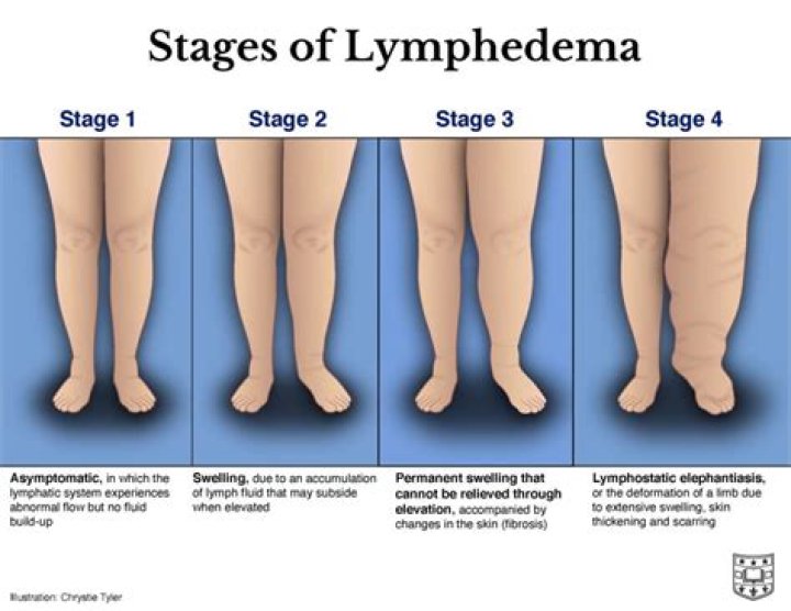 Does Grace Kinstler Have Lymphedema? American Idol Star’s Large Hips Explained