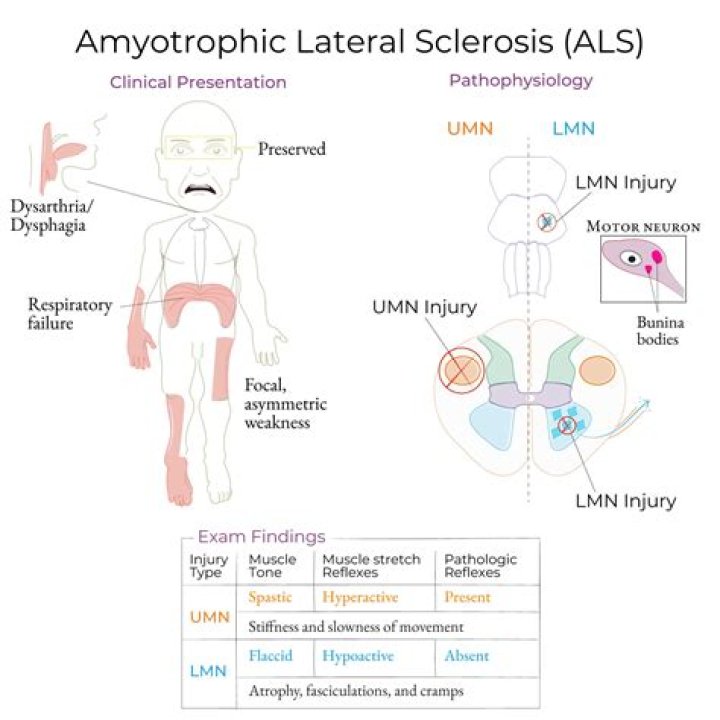 
Roberta Flack Stated That She Is Diagnosed With Amyotrophic Lateral Sclerosis 